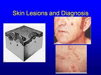 Skin Lesions and Diagnosis