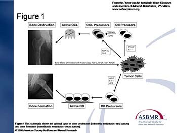 Orthopedic Treatment of Metastatic Bone Disease