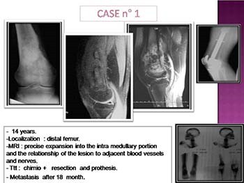 Imaging Ewings Sarcoma