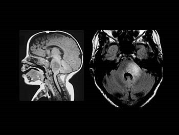 Brainstem Glioma