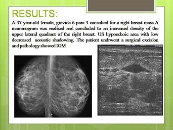 Radiologic Features of Idiopathic Granulomatous Mastitis