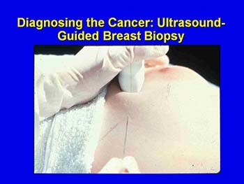 Breast Cancer Treatment: A Multidisciplinary Team Approach