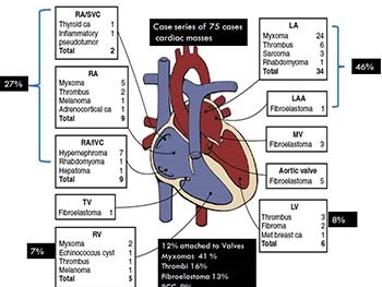 Cardiac Tumors