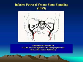 Diagnosis and Treatment of Pituitary Tumors