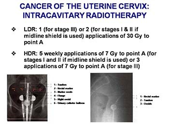 Radiation Therapy as an Effective Tool to fight cancer in Women