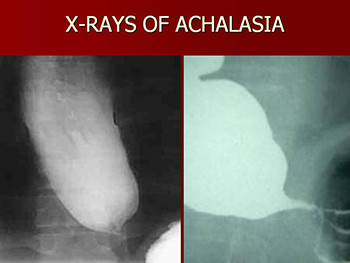 Esophageal Topics