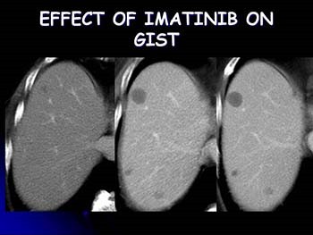 Gastrointestinal Stromal Tumors