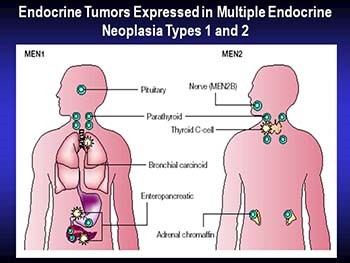 Multiple Endocrine Neoplasia Syndromes