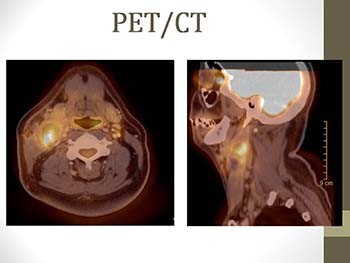 Carcinoma of Unknown Primary: The Role of Transoral Robotic Surgery