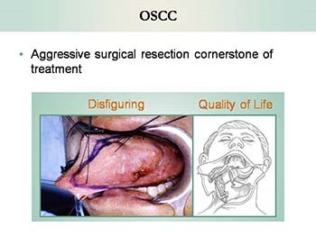 A Novel Modular Polymer Platform for the Treatment of Oral and Head And Neck Carcinoma