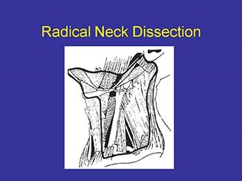 Surgical Management of the Neck in Head and Neck Cancer