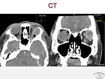 Grand Rounds Orbital Mass