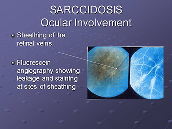 Systemic disease and the eye