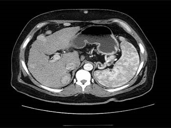 Hepatocellular Carcinoma