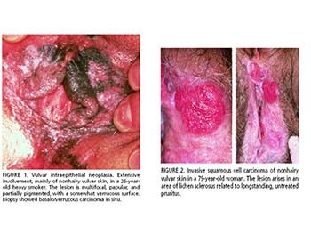 Carcinoma of the Vulva