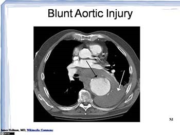 Acute Aortic Emergencies