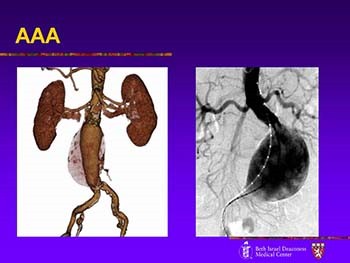 Screening Guidelines and Treatment Options for Abdominal Aortic Aneurysms