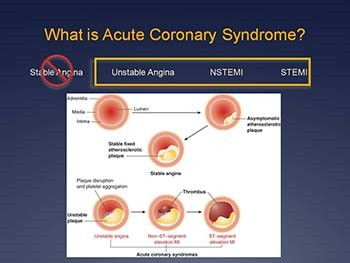 Acute Coronary Syndrome