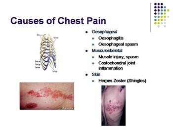 Chest Pain Cardiology in the ED