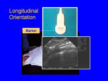 Focused Emergency Ultrasound: Evaluation of the Abdominal Aorta