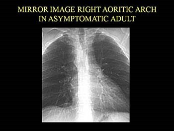 Congenital Aortic Disease