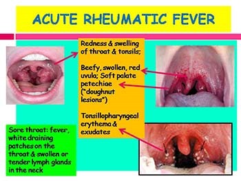 Rheumatic fever and rheumatic heart disease