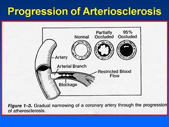 Arteriosclerosis and Coronary Heart Disease (CHD)