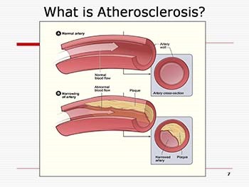 Women and Heart Disease Across the Lifespan