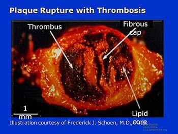 Pathogenesis of Acute Coronary Syndromes