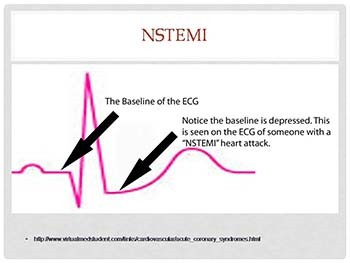 Acute Coronary Syndrome Update