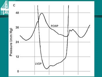 Valvular Heart Disease Mitral Stenosis