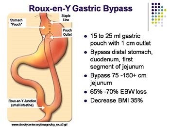 Complications and Benefits of Bariatric Surgery