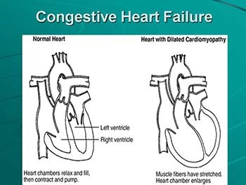 Congestive Heart Failure Case Study