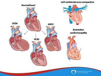 Cardiomyopathies