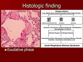 Acute Respiratory Distress Syndrome