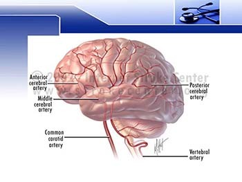 Hemorrhagic stroke