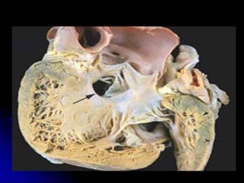 Congenital Heart Diseases