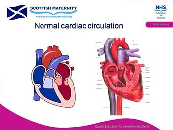 Congenital heart disease Understood