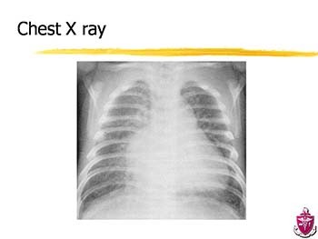 Congestive Heart Failure in Children