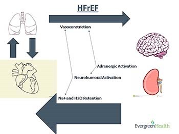 Palliative Care of Congestive Heart Failure