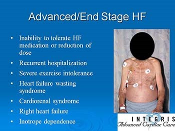 Advanced Therapies in Chronic Heart Failure