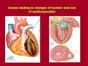 Pathophysiology of Heart Failure