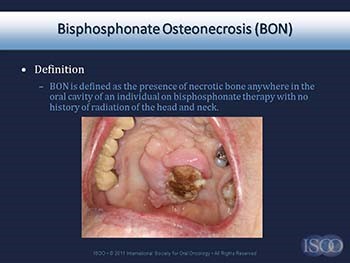 Evidence-Based Management Strategies for Oral Complication from Cancer Treatment