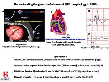 ECG grammar part 2 , section B.“Understanding the genesis  of  ECG changes  in common  non ischemic  heart diseases ”.