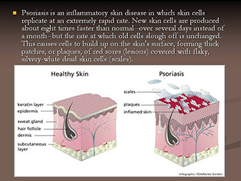 PSORIASIS