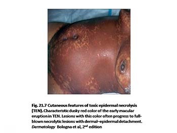 Drug Reactions - Mechanisms and Cutaneous Manifestations