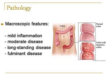 Inflammatory Bowel Disease - Ulcerative colitis (UC)