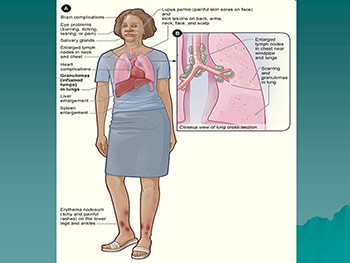 Sarcoidosis