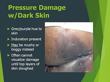 Pressure Ulcers Injuries Assessment and Treatment