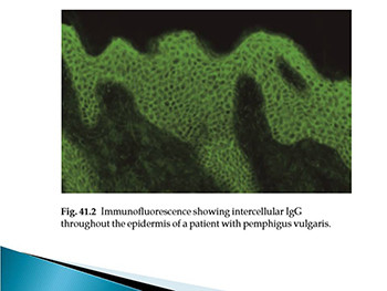 Cutaneous Autoimmune Blistering Disease